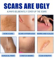 Generic Plastic Scar Removal Cream (White-Blue) - Image 5